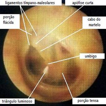 Membrana timpânica normal à otoscopia com legendas
