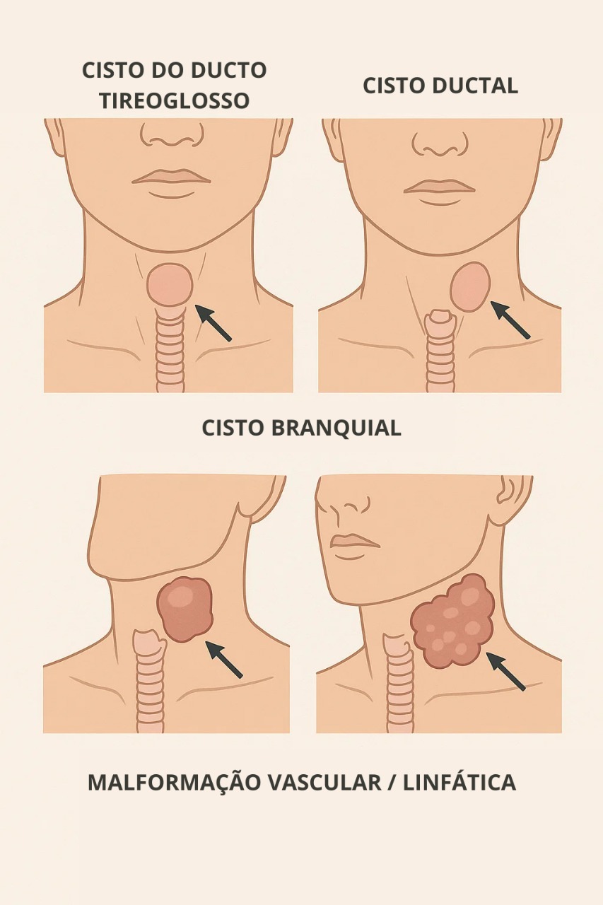 Localização dos cistos congênitos do pescoço