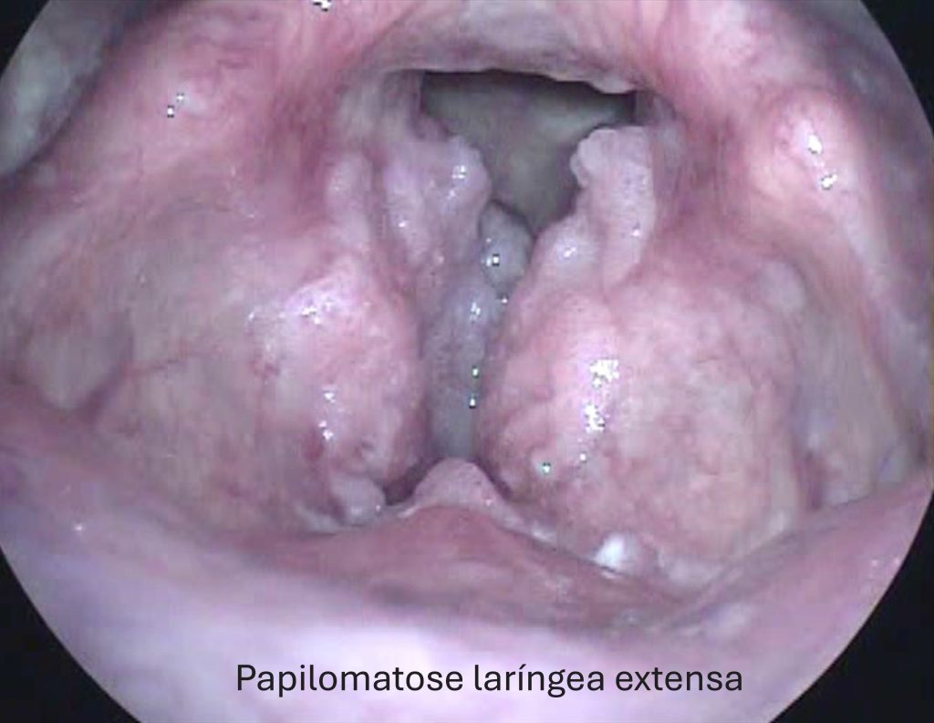 Papilomatose laríngea extensa