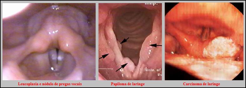Leucoplasia, papiloma e carcinoma de laringe
