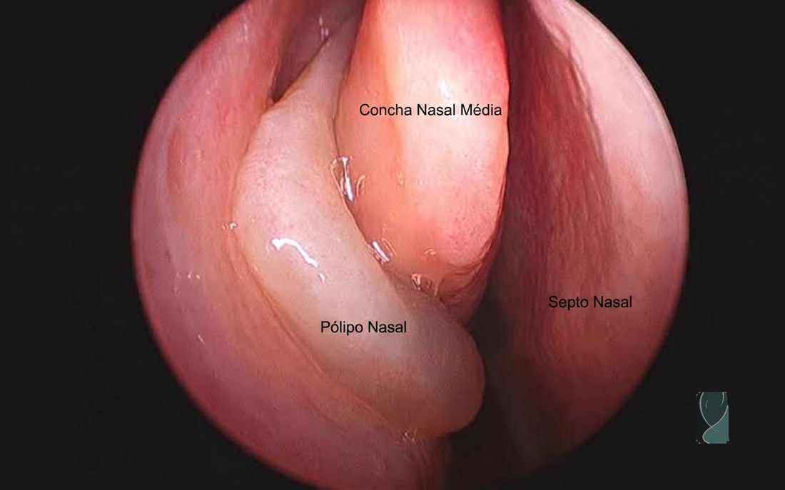 Pólipo nasal visto na endoscopia