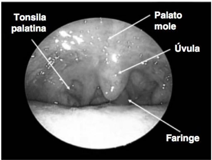 Oroscopia mostrando tonsila palatina, palato mole, úvula e parede da faringe