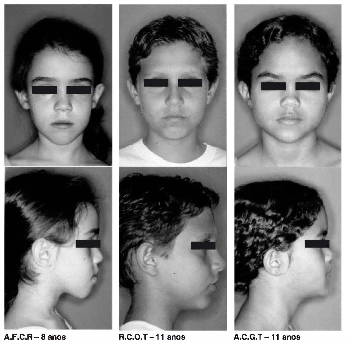 Fotos de frente e perfil de três crianças com tipos faciais diferentes