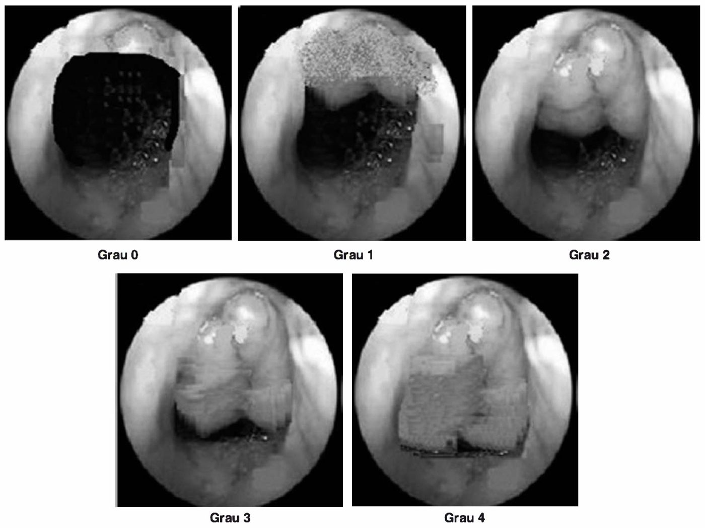 Cinco imagens endoscópicas da rinofaringe mostrando adenoide graus 0 a 4 de Brodsky
