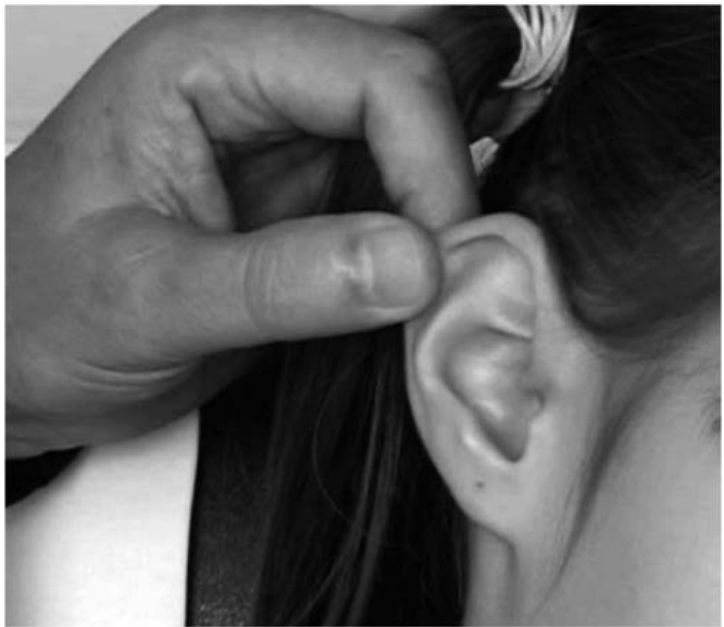Tração do pavilhão auricular para retificar o conduto