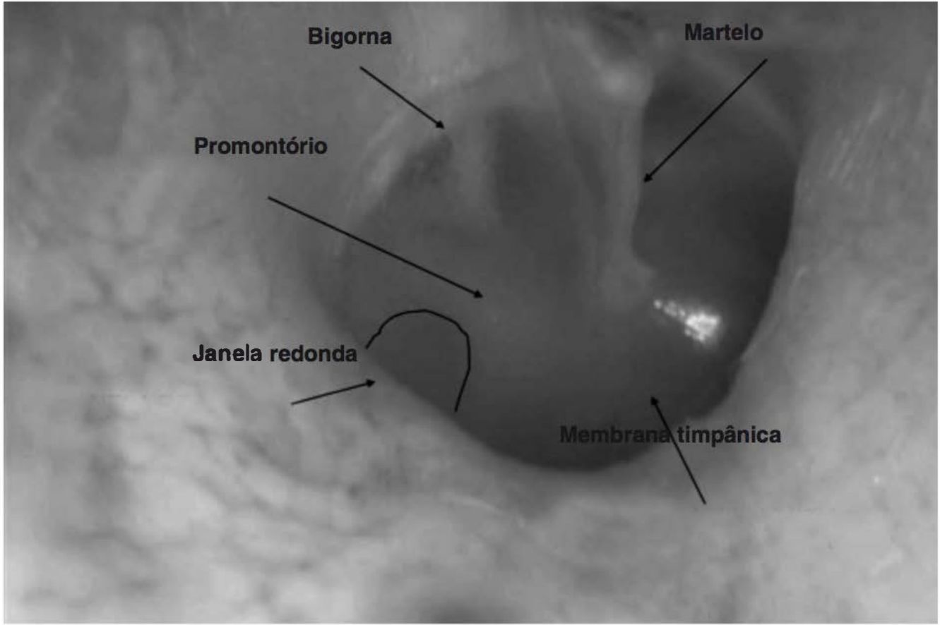 Otoscopia normal com martelo, bigorna, promontório e janela redonda