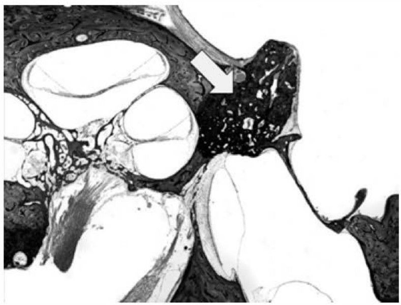 Histologia: foco otosclerótico na região anterior da platina do estribo