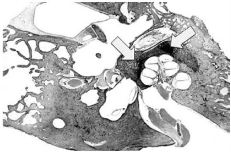 Histologia: foco otosclerótico acometendo toda a cóclea