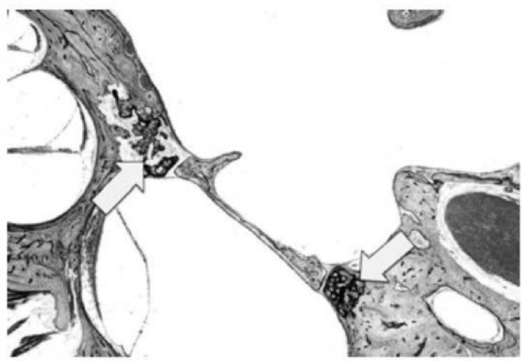 Histologia: otosclerose histológica sem repercussão clínica