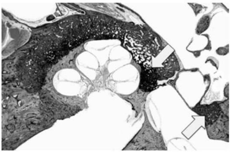 Histologia: foco em toda a cóclea e nas porções anterior e posterior da platina