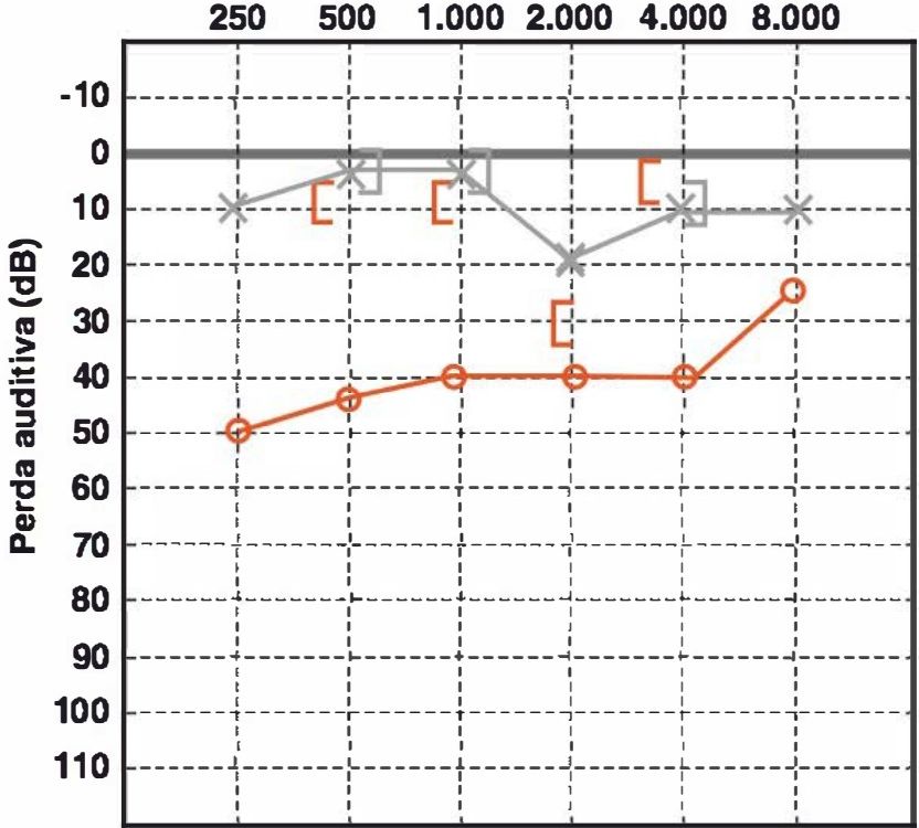 Audiometria com perda condutiva e entalhe de Carhart em 2 kHz