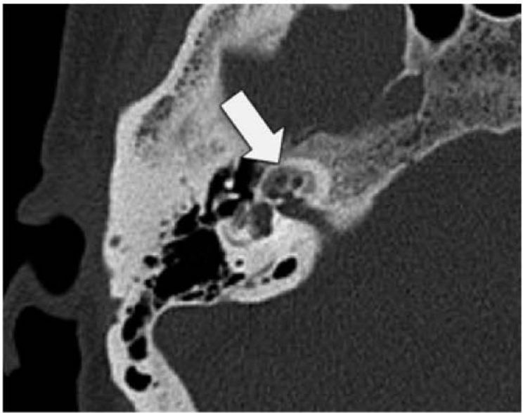 TC axial de mastoide com desmineralização da cápsula ótica