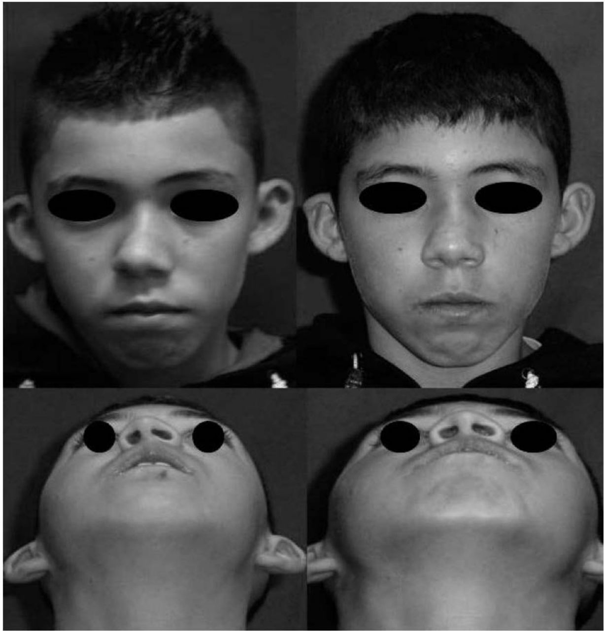 Criança em vista frontal e basal antes e depois da correção de desvio septal e da pirâmide nasal