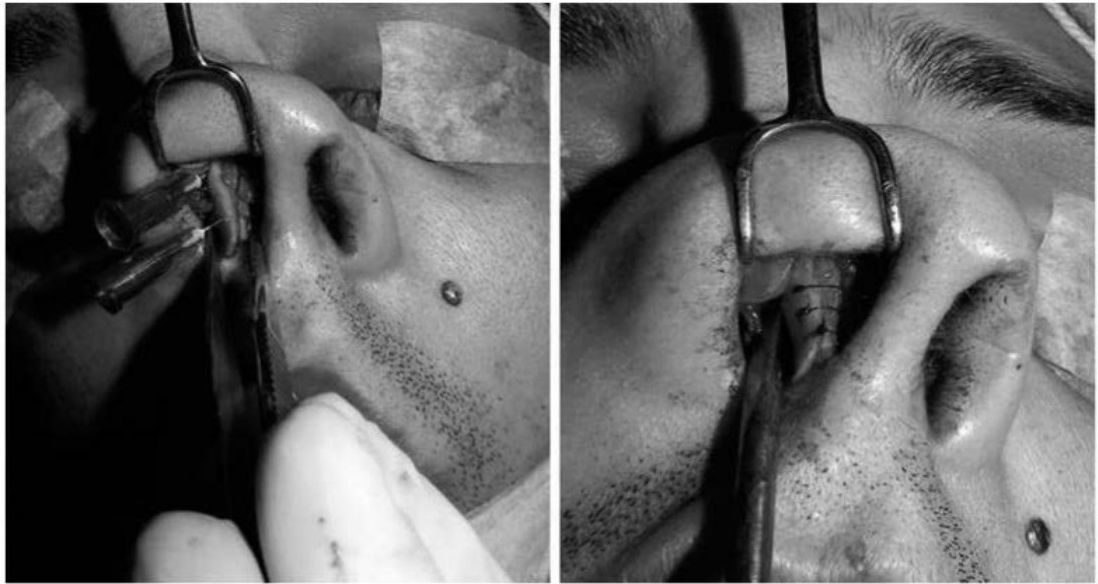 Duas fotos intraoperatórias com afastador mostrando inserção de enxertos alargadores no dorso nasal