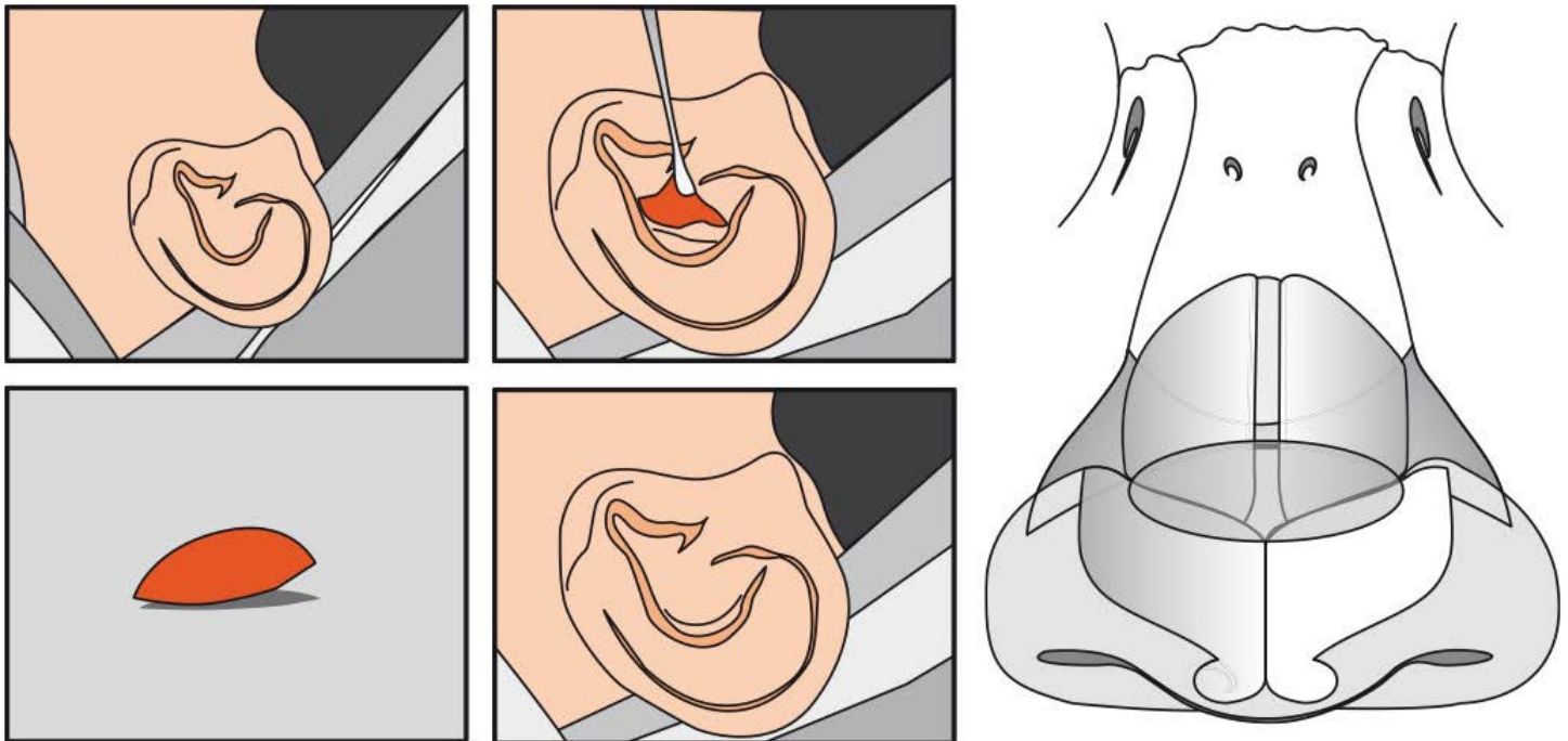 Esquema da retirada de cartilagem da concha auricular e posicionamento do enxerto em asa de borboleta sobre o dorso nasal