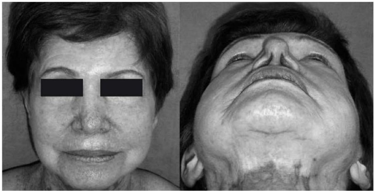 Paciente idosa em vista frontal e basal com pinçamento das asas nasais após rinoplastia