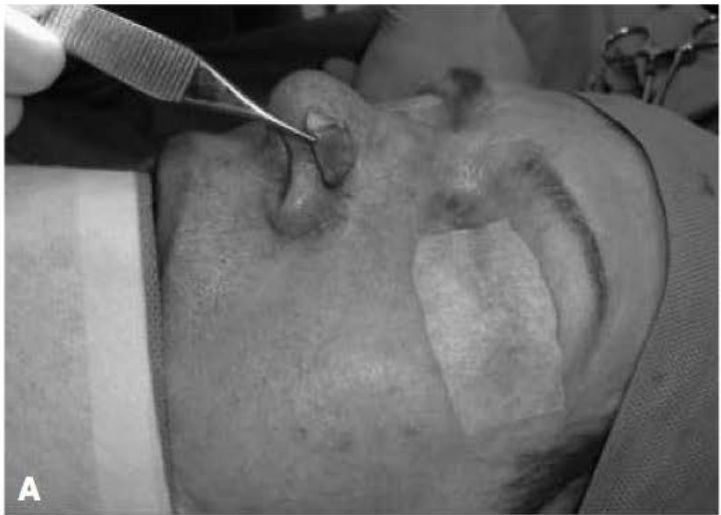 Foto intraoperatória de pinça posicionando batten graft na asa nasal
