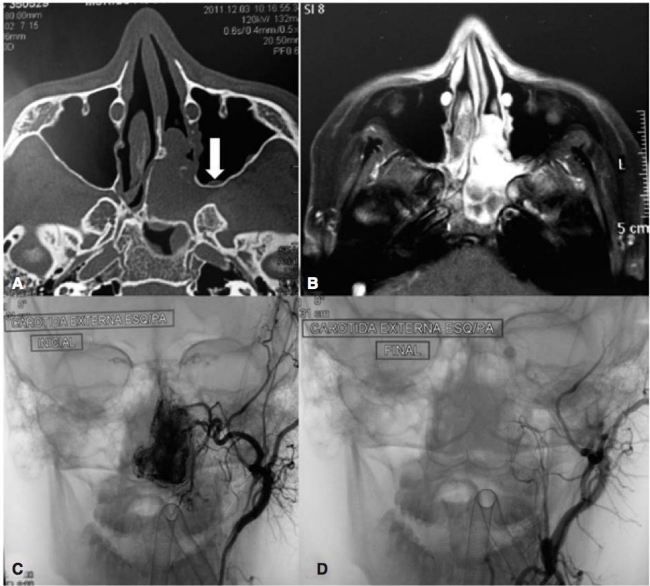 TC e RM axiais de nasoangiofibroma e arteriografias antes e depois da embolização