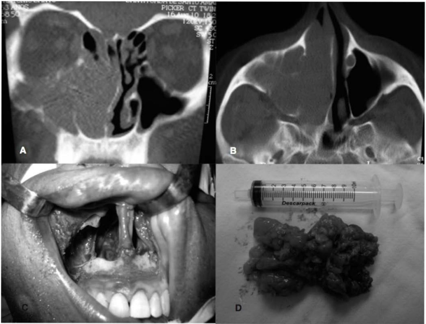 TC coronal e axial de papiloma invertido, acesso midfacial degloving e peça cirúrgica