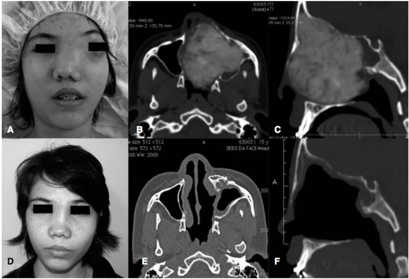 Paciente com assimetria facial e TCs de massa óssea, e controle pós-operatório