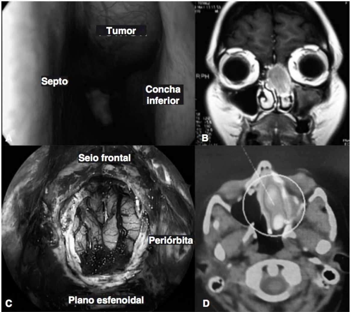 Endoscopia com tumor entre septo e concha inferior, RM coronal, visão endoscópica pós-ressecção e PET