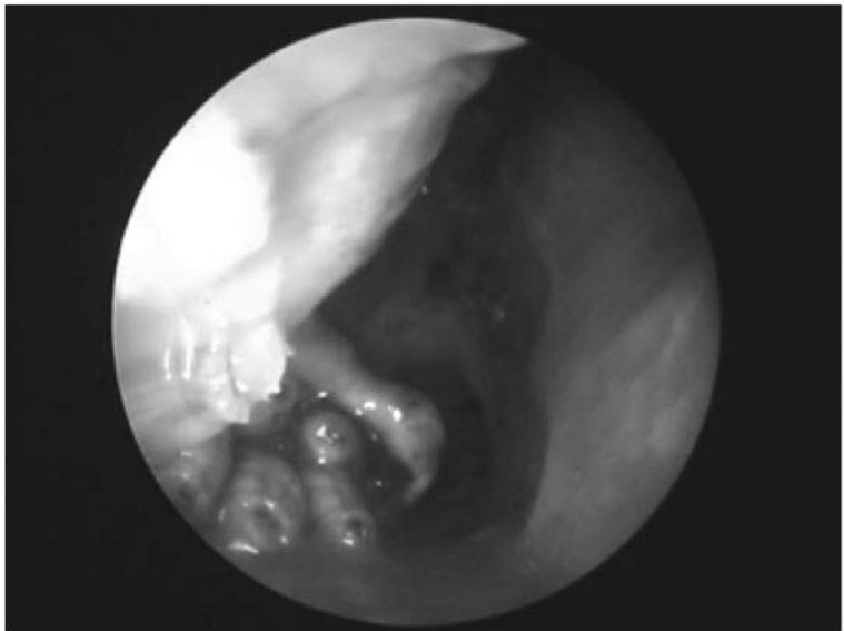 Endoscopia com larvas na cavidade nasal