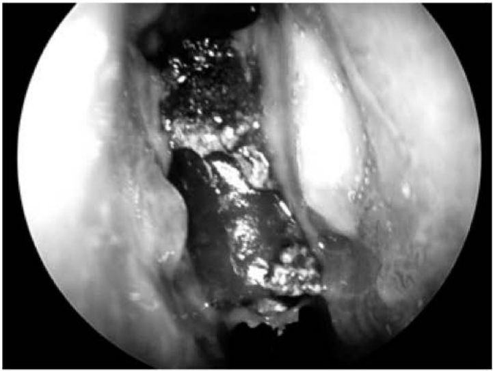 Endoscopia com massa escura irregular e incrustada na fossa nasal
