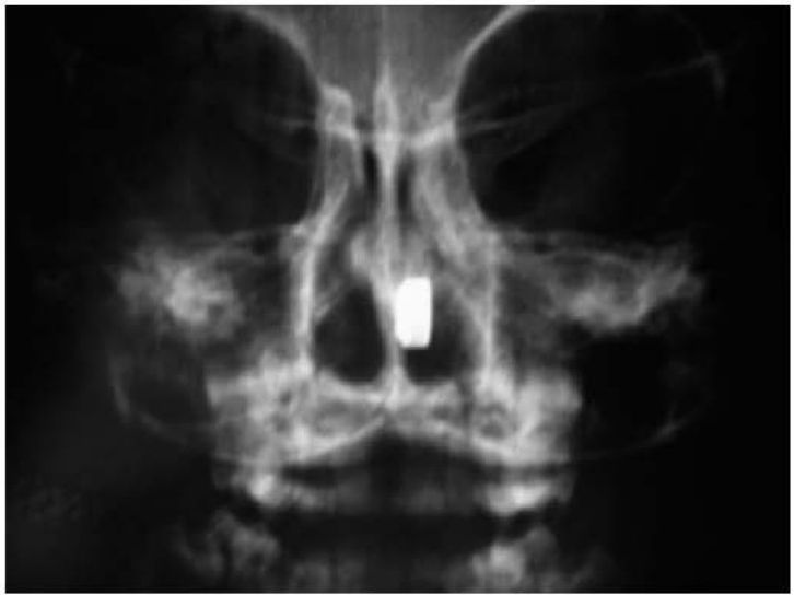 Radiografia frontal da face com objeto radiopaco retangular na fossa nasal