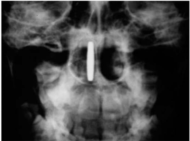 Radiografia frontal com moeda vista de perfil na fossa nasal