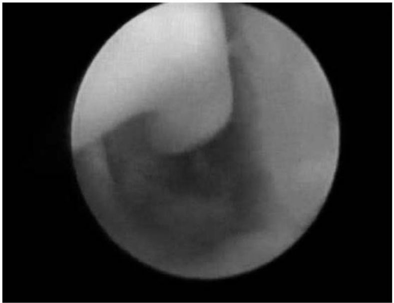 Endoscopia nasal de recém-nascido mostrando cauda do corneto inferior e fundo cego sem abertura posterior