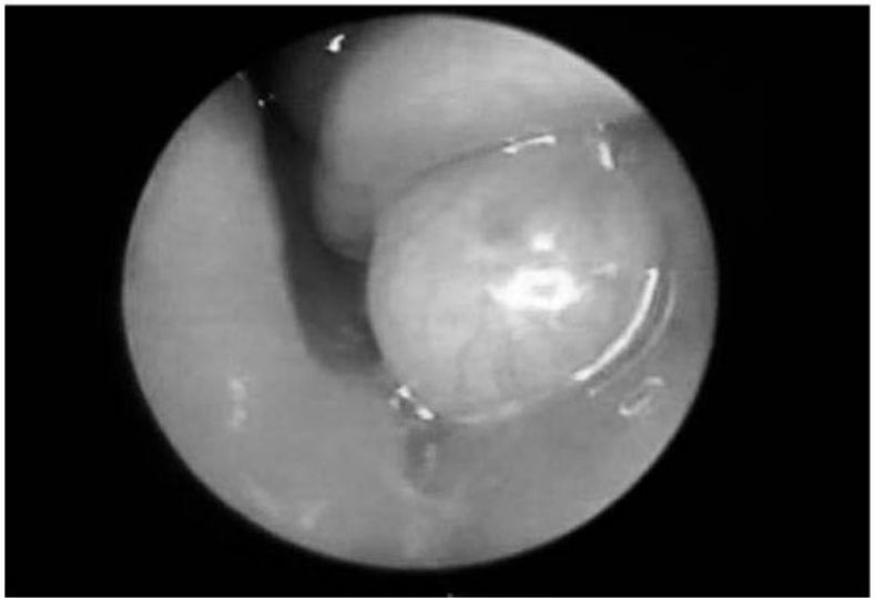 Endoscopia mostrando cisto arredondado e translúcido abaixo do corneto inferior