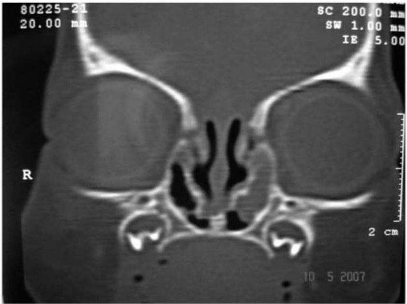 TC coronal com dilatação bilateral dos ductos nasolacrimais
