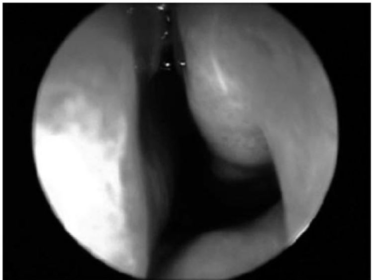 Endoscopia da fossa nasal esquerda com hipertrofia de concha inferior e secreção hialina