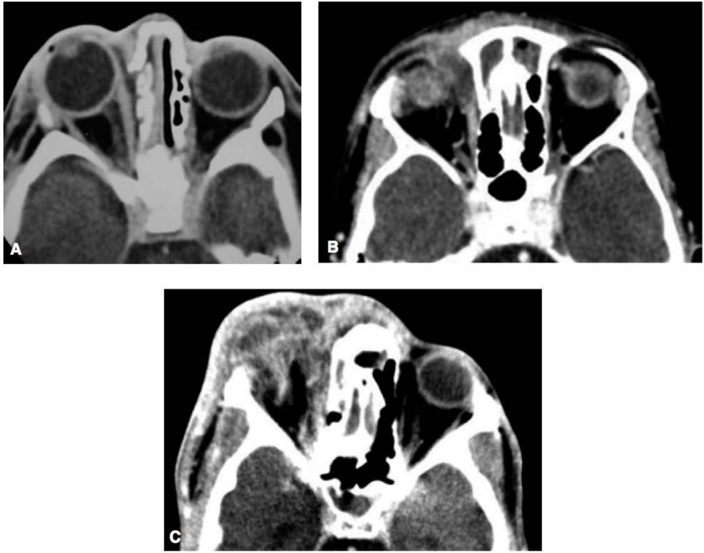 TC com contraste axial: celulite orbitária, abscesso subperiosteal e abscesso orbitário à direita