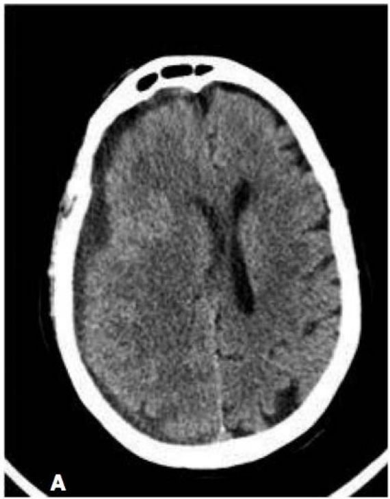 TC de crânio sem contraste com empiema subdural em crescente