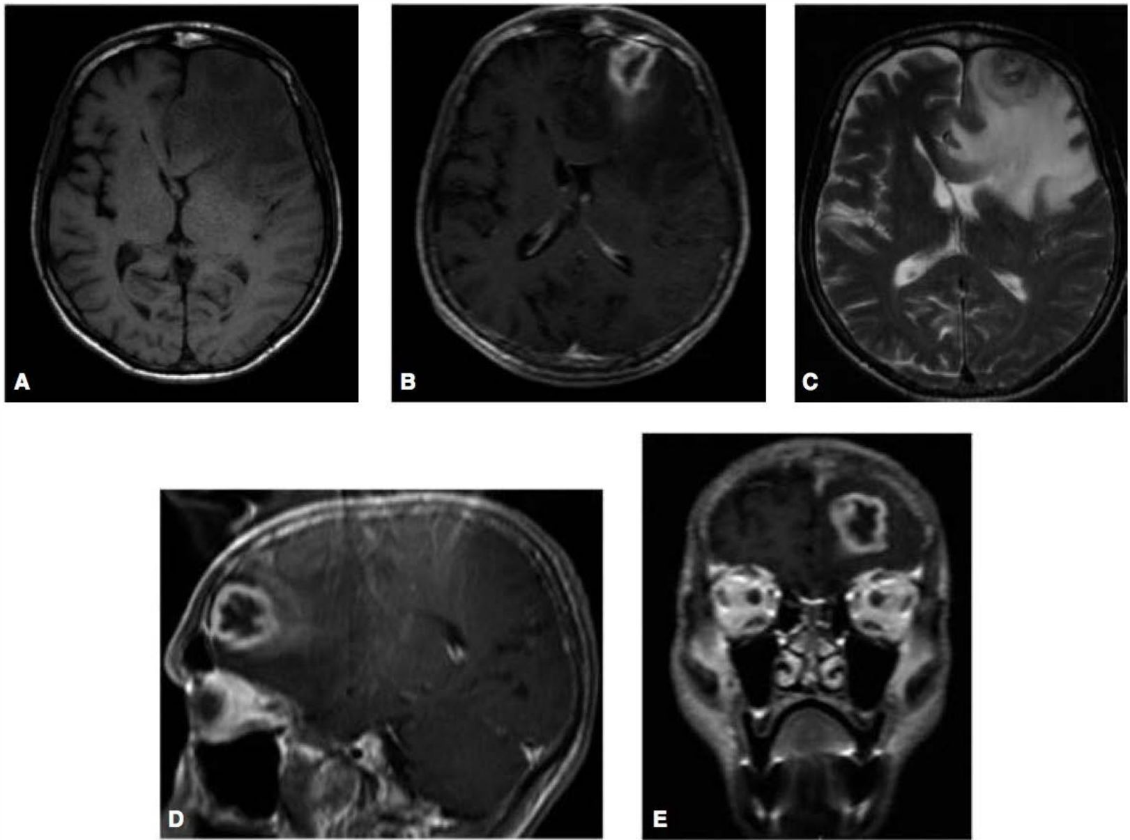 RM de abscesso cerebral frontal: T1 sem e com contraste, T2, sagital e coronal