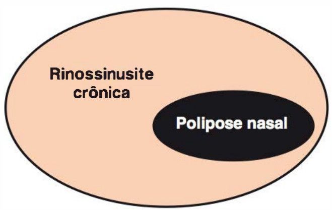Diagrama: polipose nasal como subconjunto da rinossinusite crônica