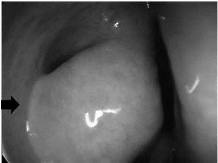 Endoscopia com edema de concha média no meato médio direito