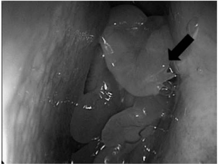 Endoscopia com pólipos nasais no meato médio esquerdo