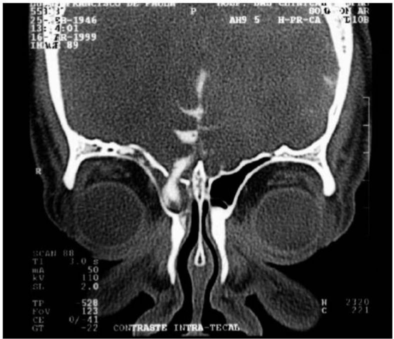 Cisternotomografia coronal mostrando meningocele frontal com contraste intratecal
