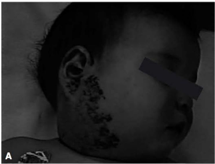 Lactente de 3 meses com hemangioma cutâneo em face e pescoço