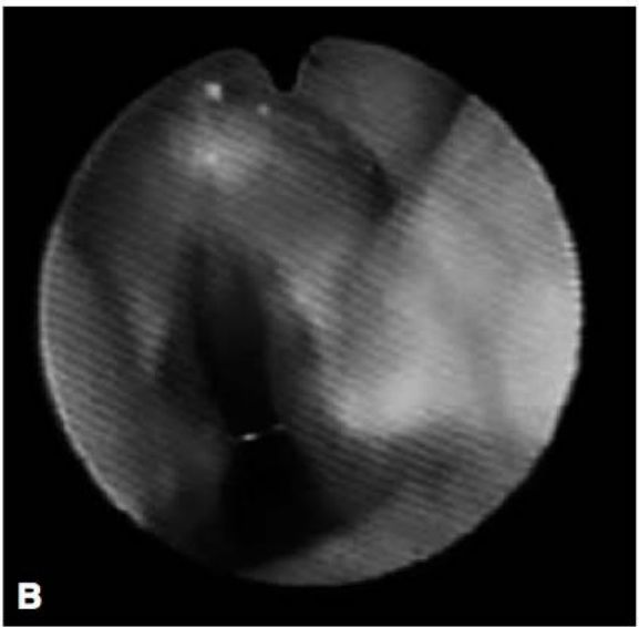 Videolaringoscopia com hemangioma subglótico lateral e posterior