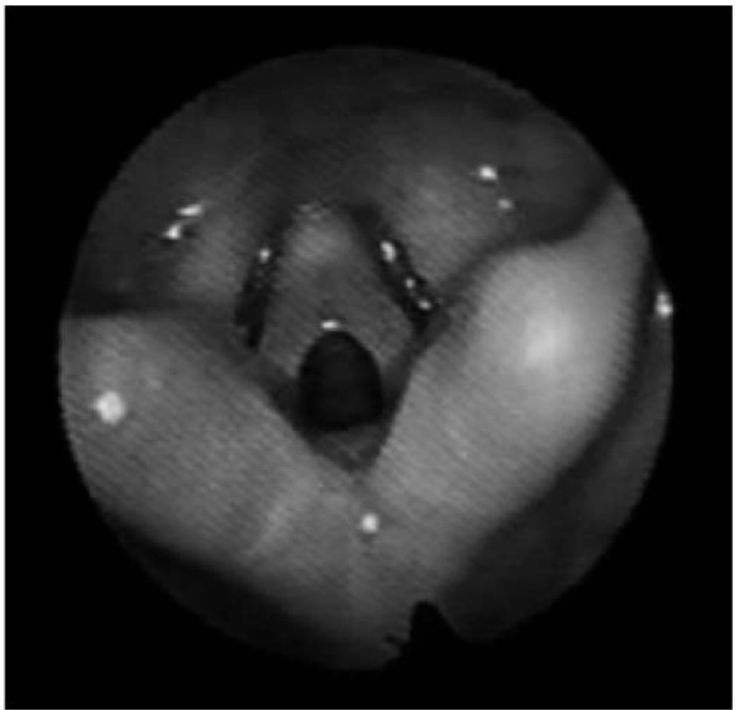 Membrana laríngea anterior na videofibronasolaringoscopia