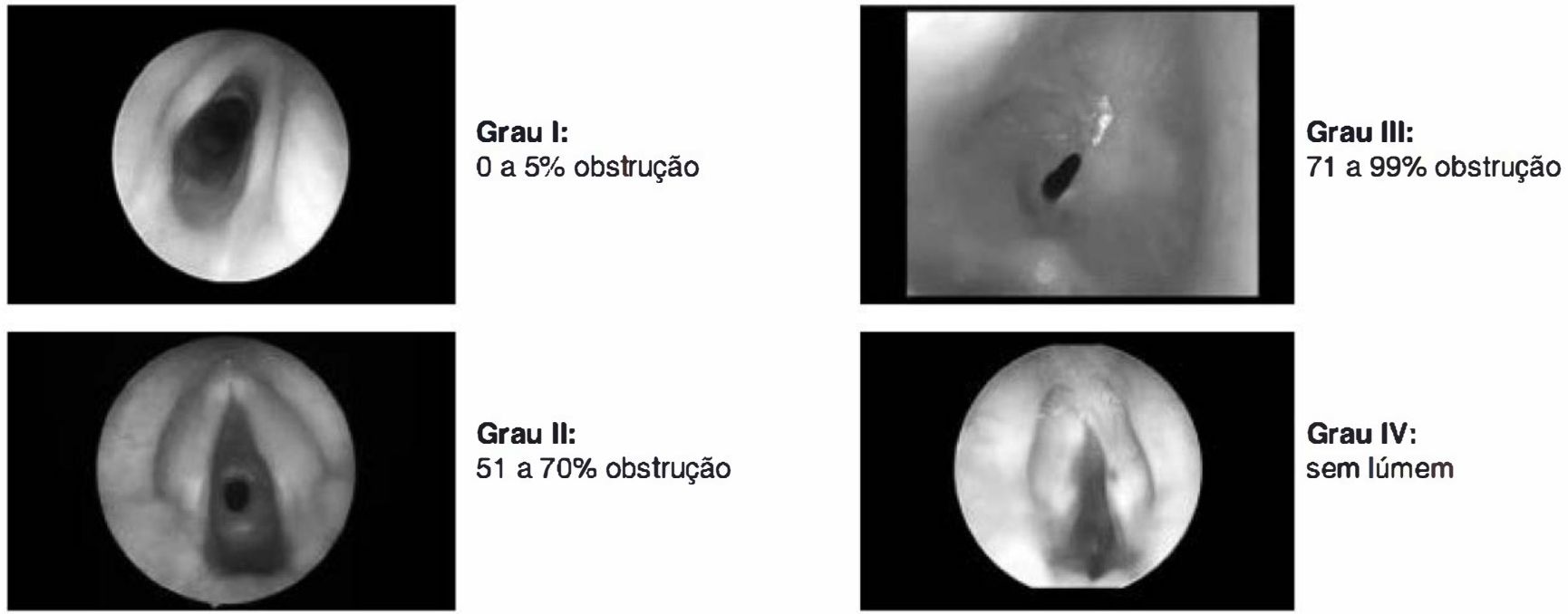 Imagens endoscópicas dos graus I a IV de Myer-Cotton