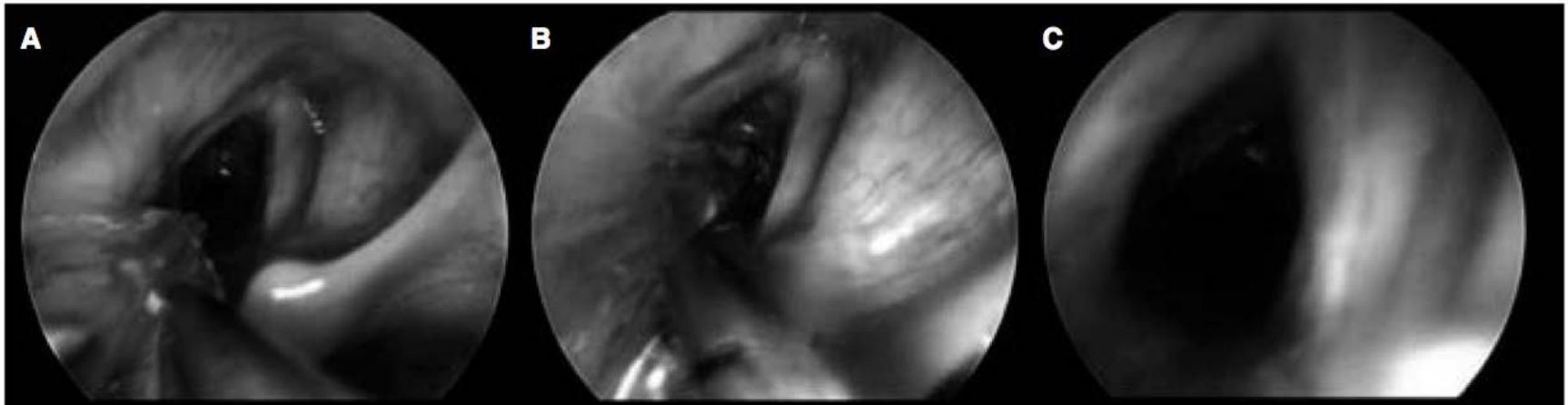 Laringoplastia com balão de angioplastia em três etapas
