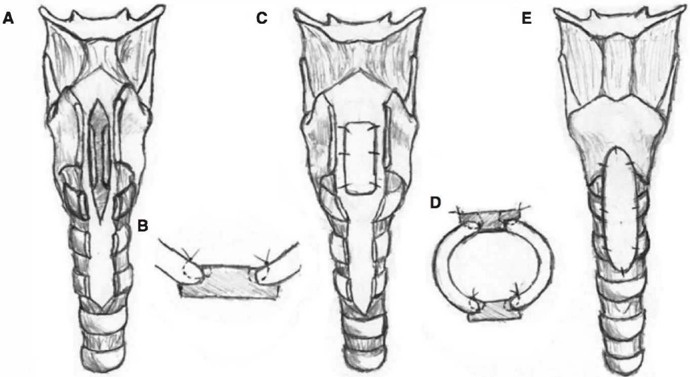 Etapas da reconstrução laringotraqueal com enxertos anterior e posterior