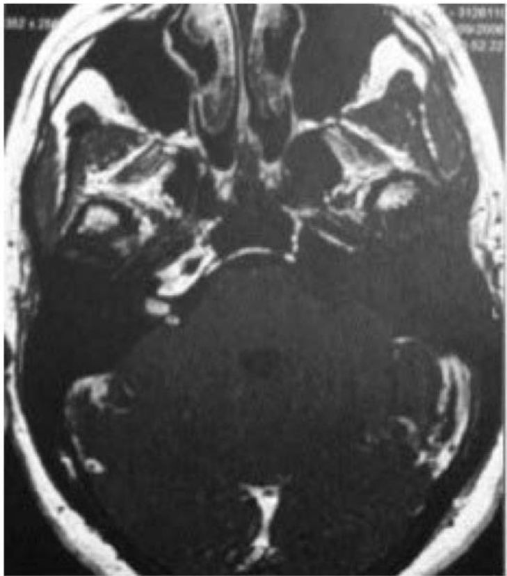 RM axial com pequeno schwannoma vestibular intracanalicular à direita