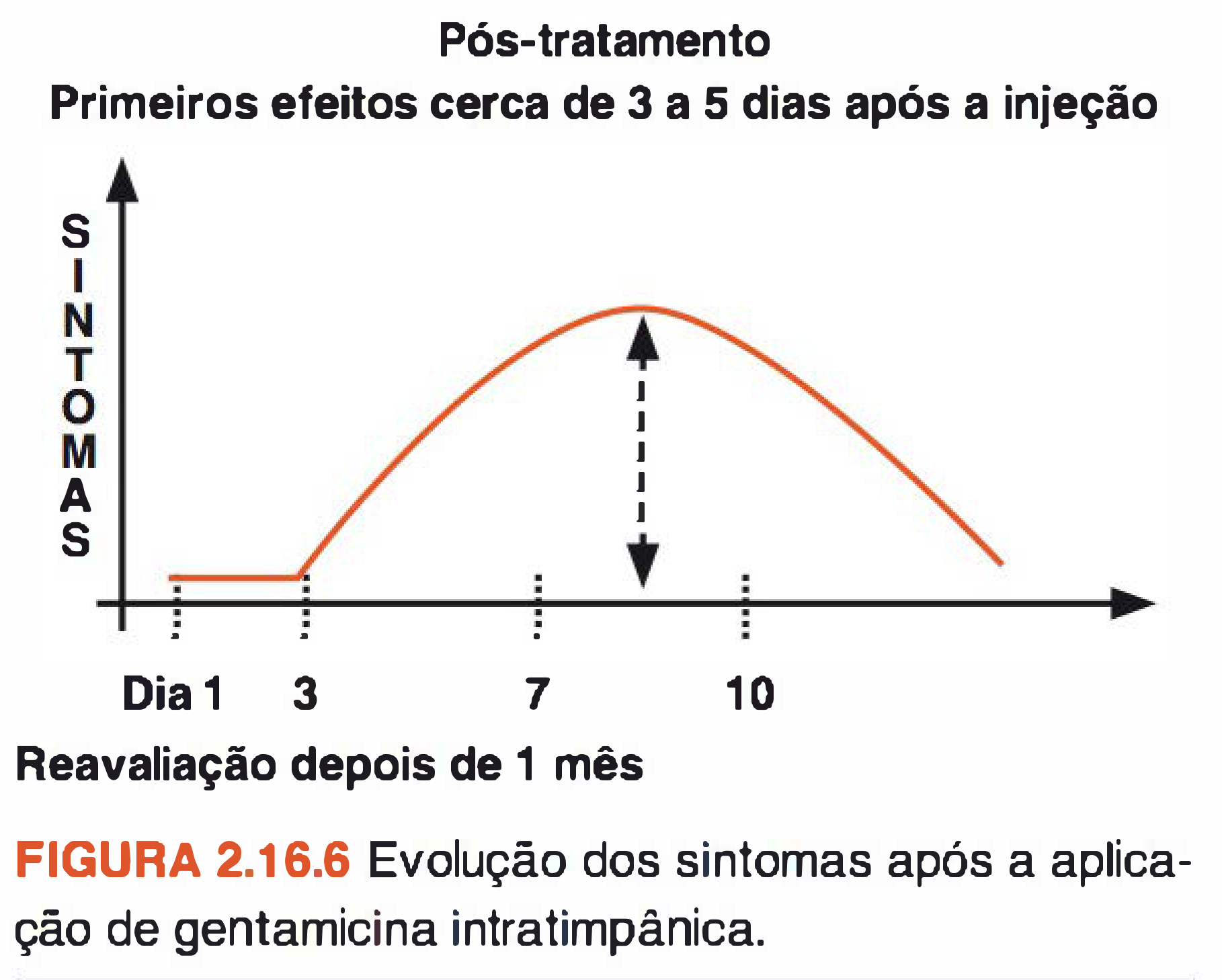Gráfico de sintomas após gentamicina intratimpânica: estáveis até o dia 3, pico entre os dias 7 e 10, reavaliação após 1 mês