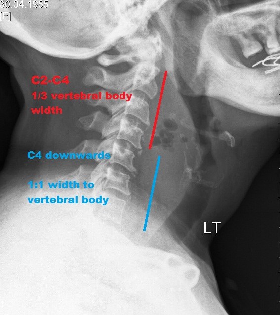 Radiografia cervical em perfil avaliando partes moles pré-vertebrais