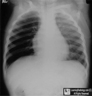 Radiografia de tórax com hiperinsuflação unilateral por corpo estranho